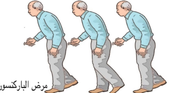 مرض الباركنسون